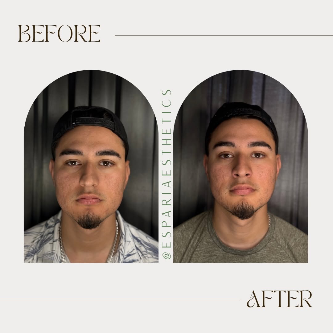 Espari client before-and-after at rest